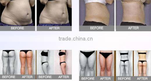 liposonix hifu/ultrasonic wrinkle removal/hifu wrinkle removal