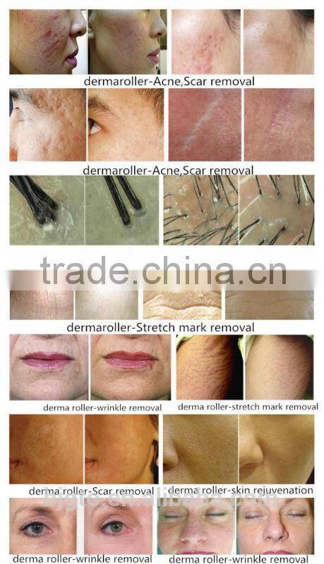 GTO 540needles dermaroller for wrinkle,scar,acne,pigmentation removal