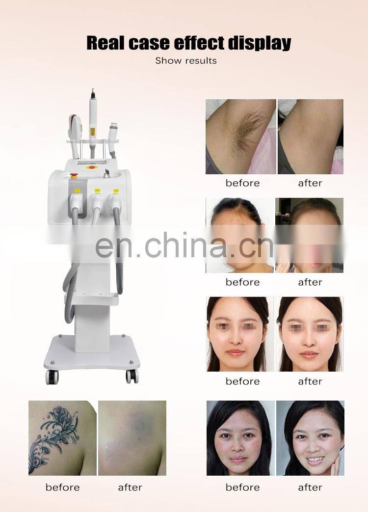 Portable 3 in 1 DPL hair removal RF skin lifting skin rejuvenation pico tattoo removal multifunctional