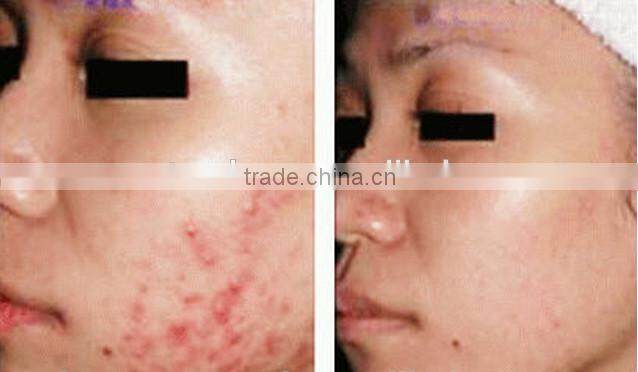 co2 fractional laser machine , co2 laser power supply/ Machines of fractional co2 laser