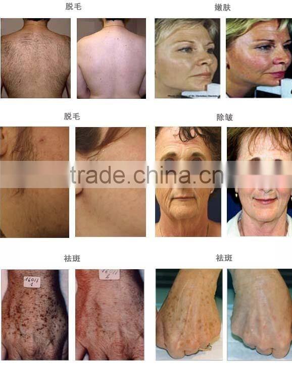 ipl sapphire crystal/ipl soft light/ipl-beauty equipment