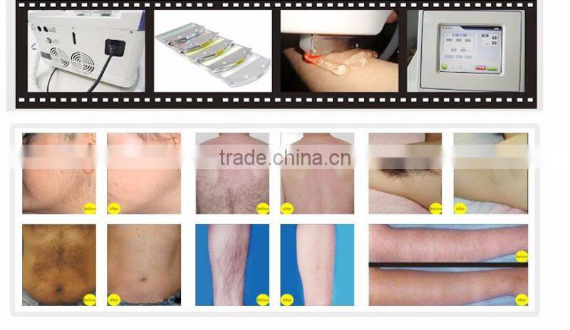 2 year warranty ipl laser at home skin rejuvenation ipl hair removal shr ipl