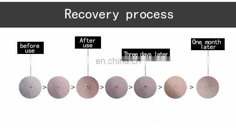 Plasma Skin Therapy 2 In 1 Plasma Device Acne Removal Anti Aging Plasma Pen Skin Care Machine