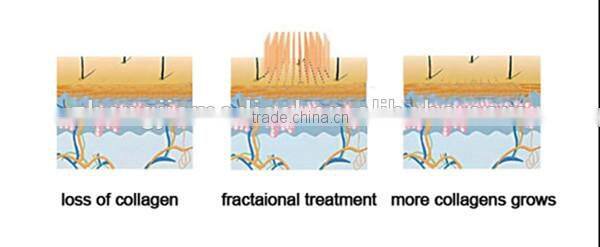 Medical ce approval fractional co2 laser portable medical /fractional co2 laser mini