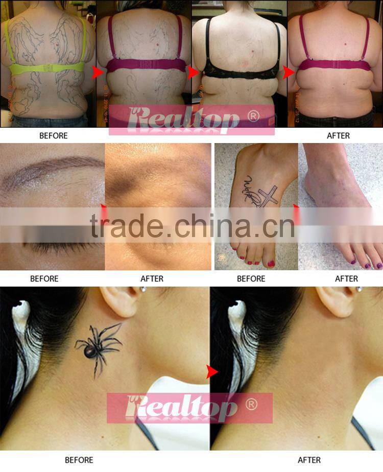 Hottest factory price!Best effect wind system closed circulating and cooling system Q switch colors laser tattoo removal machine