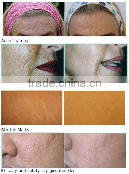 Derma roller system / micro needle derma roller / titanium micro needle roller system
