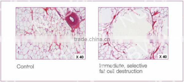 Non-invasive Fat Cell Destruction Fast Weight Loss HIFU Body Slimming Machine