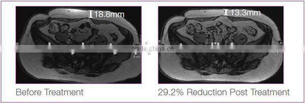 Ultrashape HIFU Body Slimming Machine ultrasonic lipolysis slimming machine