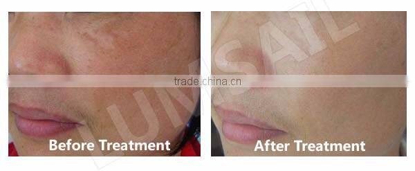 PDT Beauty Machine LED Phototherapy Anti Aging Machine