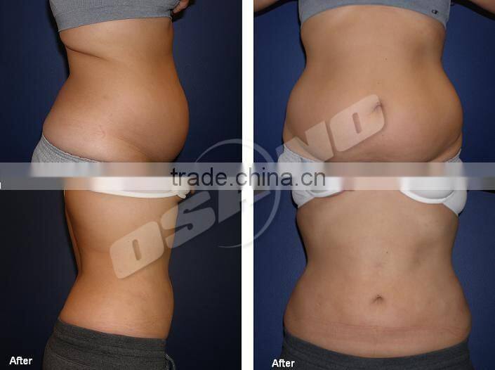 2015 Freezing Fat Machine Cryo Liposuction