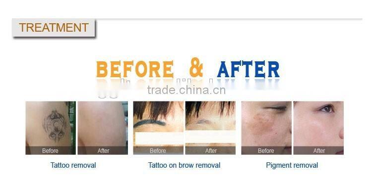 Christmas promotion 2000mj big power q switch nd yag laser