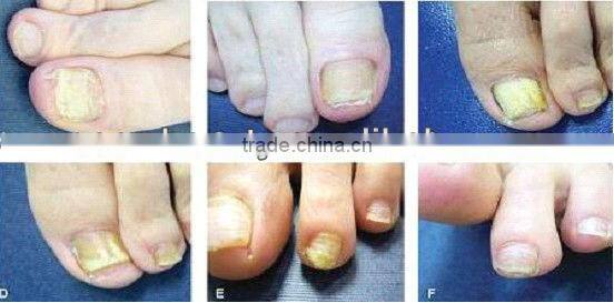 Best& amazing experienced ND:yag laser hair removal/Vascular lesion for clinics