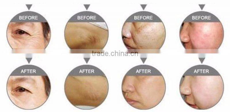 Professional ipl hair removal , powerful beuaty laser ipl