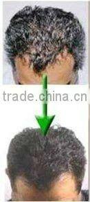 BREAKTHROUGH HAIR LASER TREATMENT