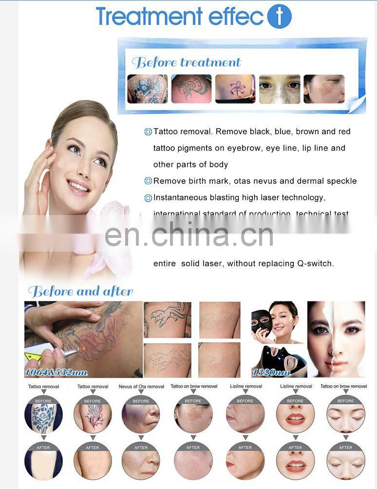 2020 Weifang Mingliang Best Selling Distributor Wanted Portable Nd Yag Laser Tattoo Removal