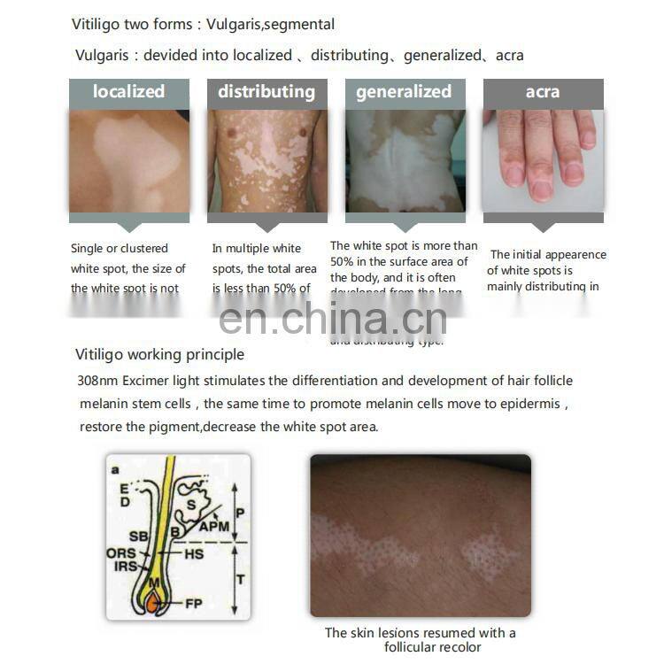 Sales 308nm 310nm uv led/led 308nm/excimer laser 308nm psoriasis vitiligo laser uv lamp