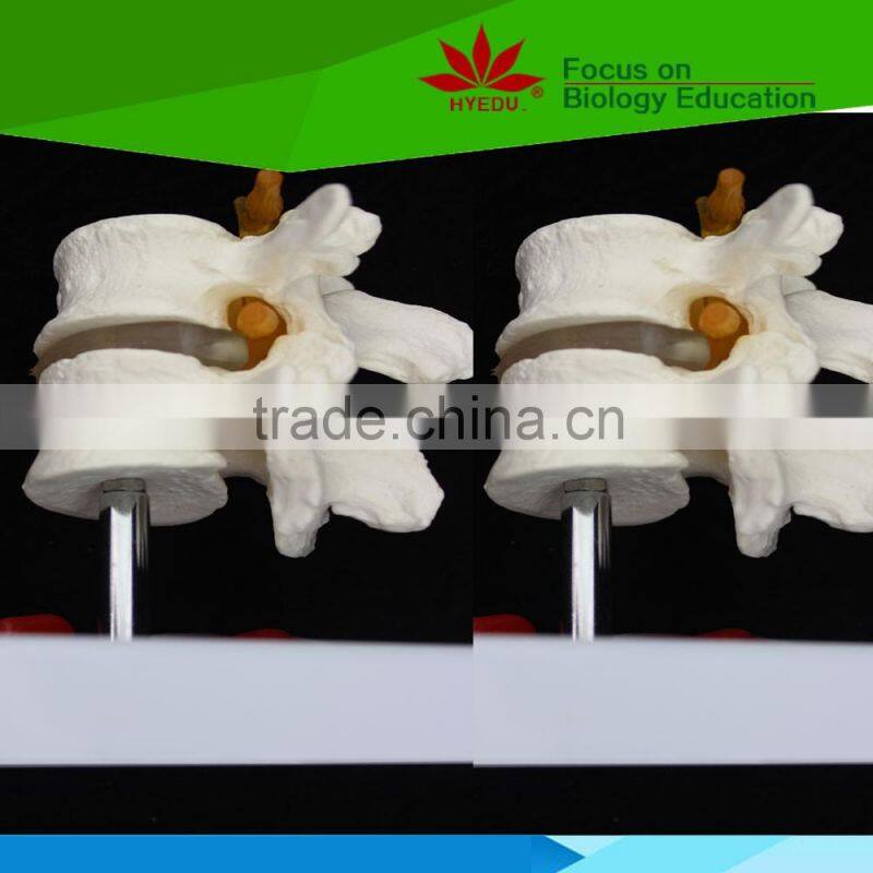 High quality for medical educational supply 2 lumbar vertebrae skeleton model with hernia and prolapsed intervertebral disc