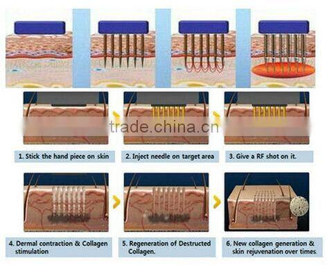 Personal care and beauty series product fractional rf skin lifting machine