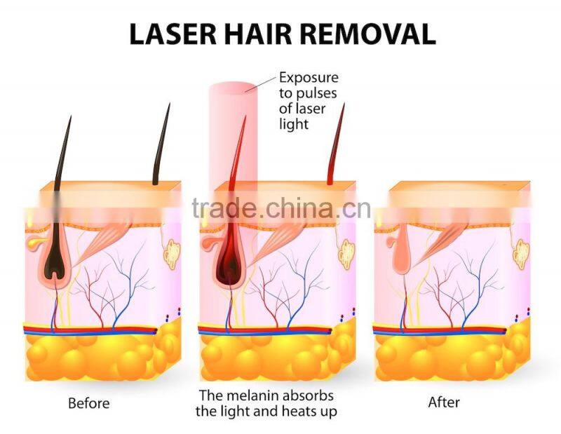 IPL upgraded skin rejuvenation hair removal 2000w machine