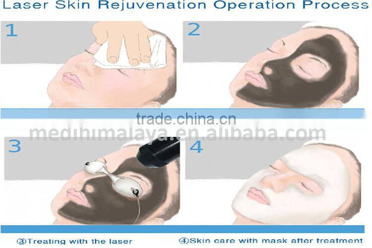 With medical CE 1064nm 532nm Q switch nd yag laser for tattoo removal