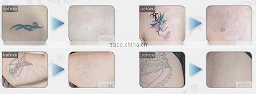 Professional best cooling system q switch nd:yag tattoo removal laser machine with good result