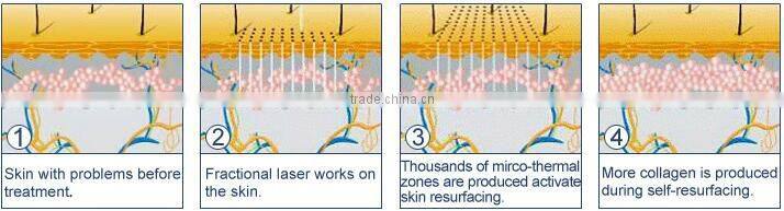 2016 Co2 Laser equipment /co2 fractional laser machine