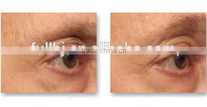 The Most Impressive Safe Beauty Therapy Radio Frequency For Home Use Portable Machine