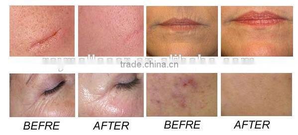 2016 Professional Wrinkle Remover Laser Equipment CO2 Fractional