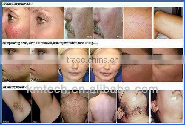 elight 2 in 1 professional home hair removal