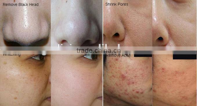 Factory provide Acne Treatment Machine with Oxygen Jet Peel skin care facial machine