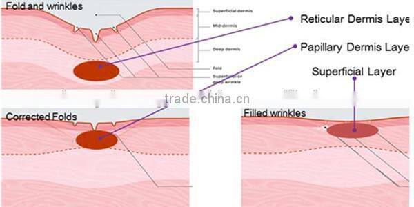 2014 professional radiofrequency micro needle rf fractional&fractional rf microneedle machine