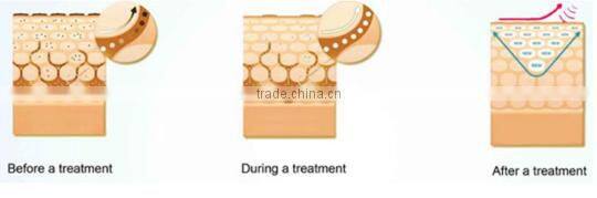 vascular vein spider vein removal rf / high power spider vein removal machine / 30mhz spider vein removal device