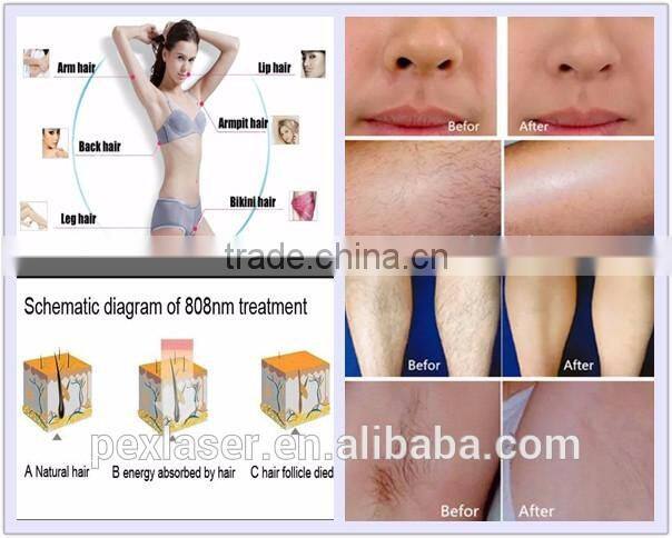 2016 808 nm laser diode portable hair removal