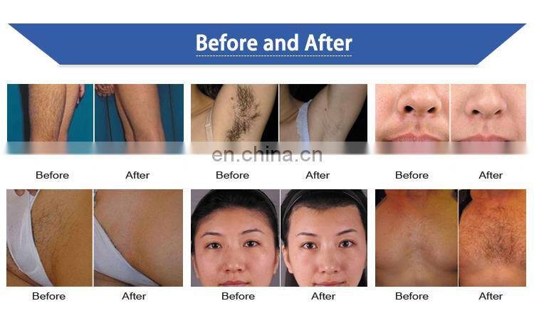 808 nm diode laser machine, laser hair removal 808nm diode