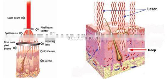 Best Selling in USA Professional Fractional Co2 Laser Stretch Mark Removal Machine