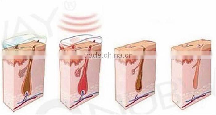 Factory direct supply- Professional IPL laser hair removal beauty machine