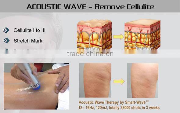 Radial Acoustic Wave Therapy SWT Therapy Cellulite Reduce Machine