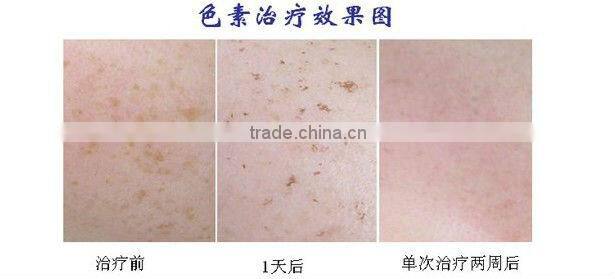 Agency wanted for scar removal rf CO2 fractional laser(60w)