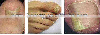 laser varicose spider veins removal machine with 1064nm wavelength-P003