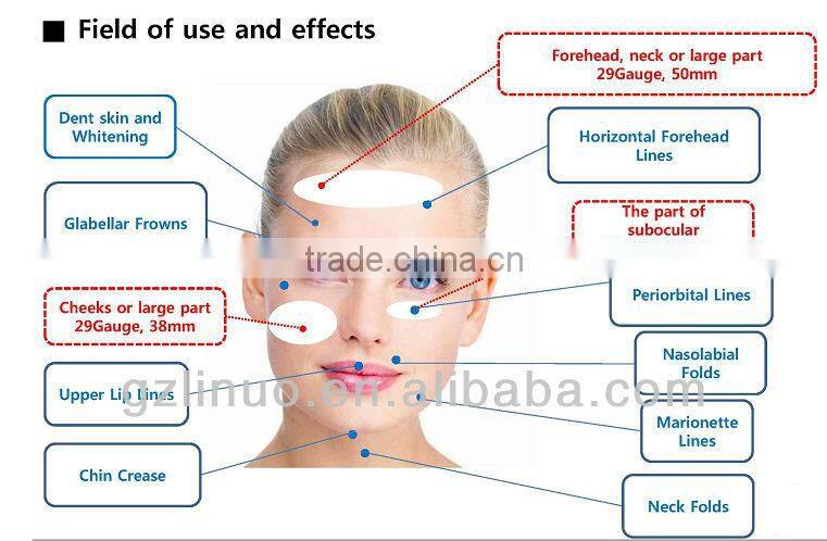 Cog face lifting PDO Thread