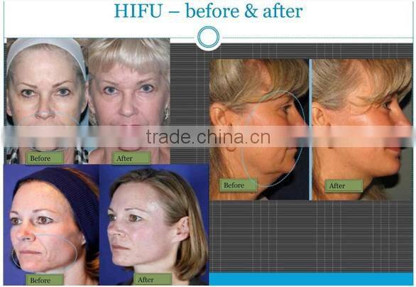 HF-118 High frequency HIFU for anti aging wrinkle beauty machine