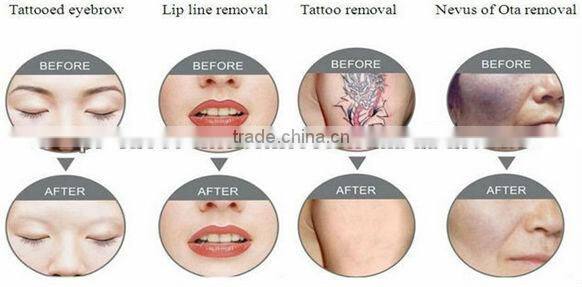 2015 new arrival first class cheap portable laser machine for tattoo removal