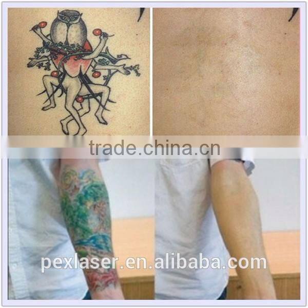 ND yag q-switched laser tattoo removal machine/1064nm
