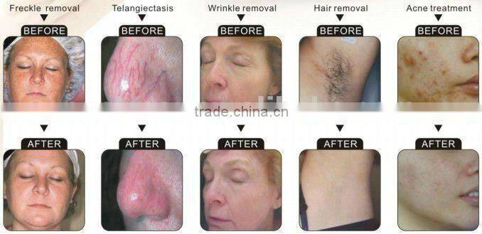 SUSLASER Elight laser hair removal machine