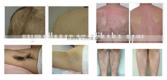 Immediately Depilation Beauty Equipment Manufacture Permanent Hair Remover 808nm Diode Laser