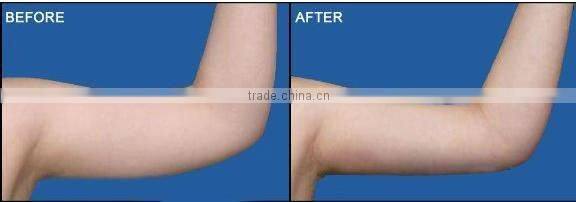 F006-Ultrasound cavitation belly Fat Loss Slimming machine
