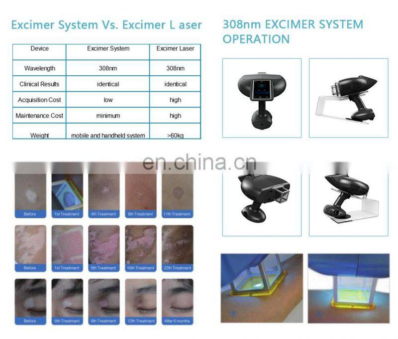 Portable Mini UVB Lamps Psoriasis Vitiligo Treatment Machine 308 Excimer Laser For Skin Disease