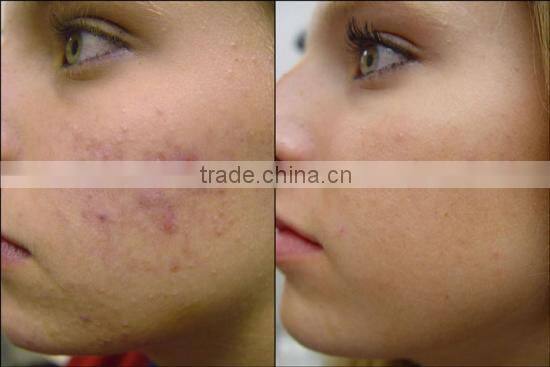 40W China most Professional skin analyzing co2 fractional laser