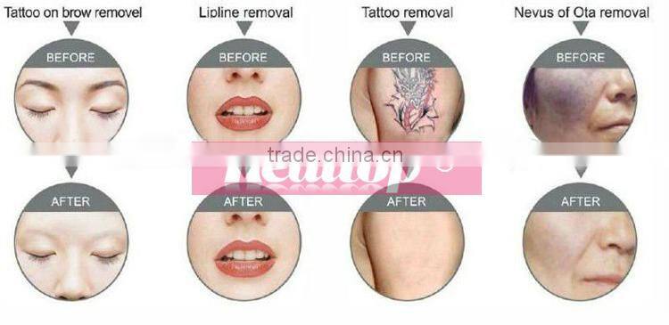 Inventions and innovations 2016 1064 nm 532nm q switch nd yag laser washing tatto machine removing ink tattoo machine kit