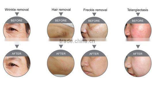 SH-2 2016 Most popular beauty equipment new style SHR /OPT/IPL+RF Multifunctional ipl hair removal opt shr ipl